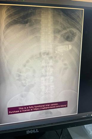 Man swallows entire Nokia 3310 phone - and has to undergo surgery to remove it 2 m2
