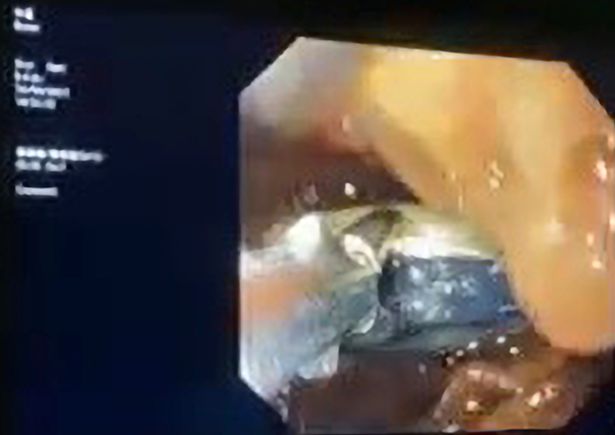 Man swallows entire Nokia 3310 phone - and has to undergo surgery to remove it 3 m3