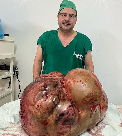 Doctors Remove 100-Pound Tumor From Brazilian woman During Surgery 