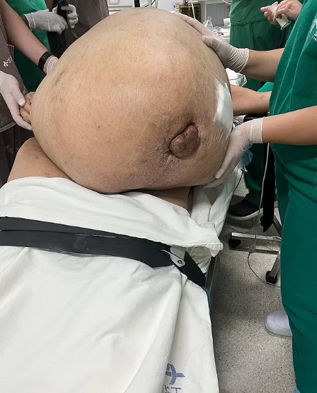 Doctors Remove 100 Pound Tumor From Brazilian woman During Surgery 3