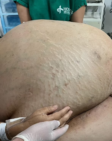Doctors Remove 100-Pound Tumor From Brazilian woman During Surgery 