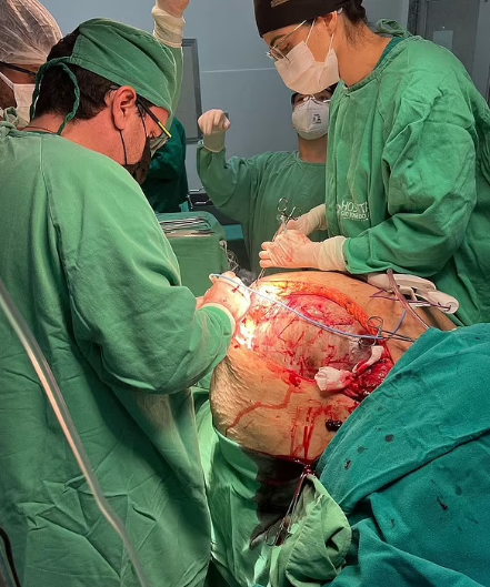Doctors Remove 100-Pound Tumor From Brazilian woman During Surgery 