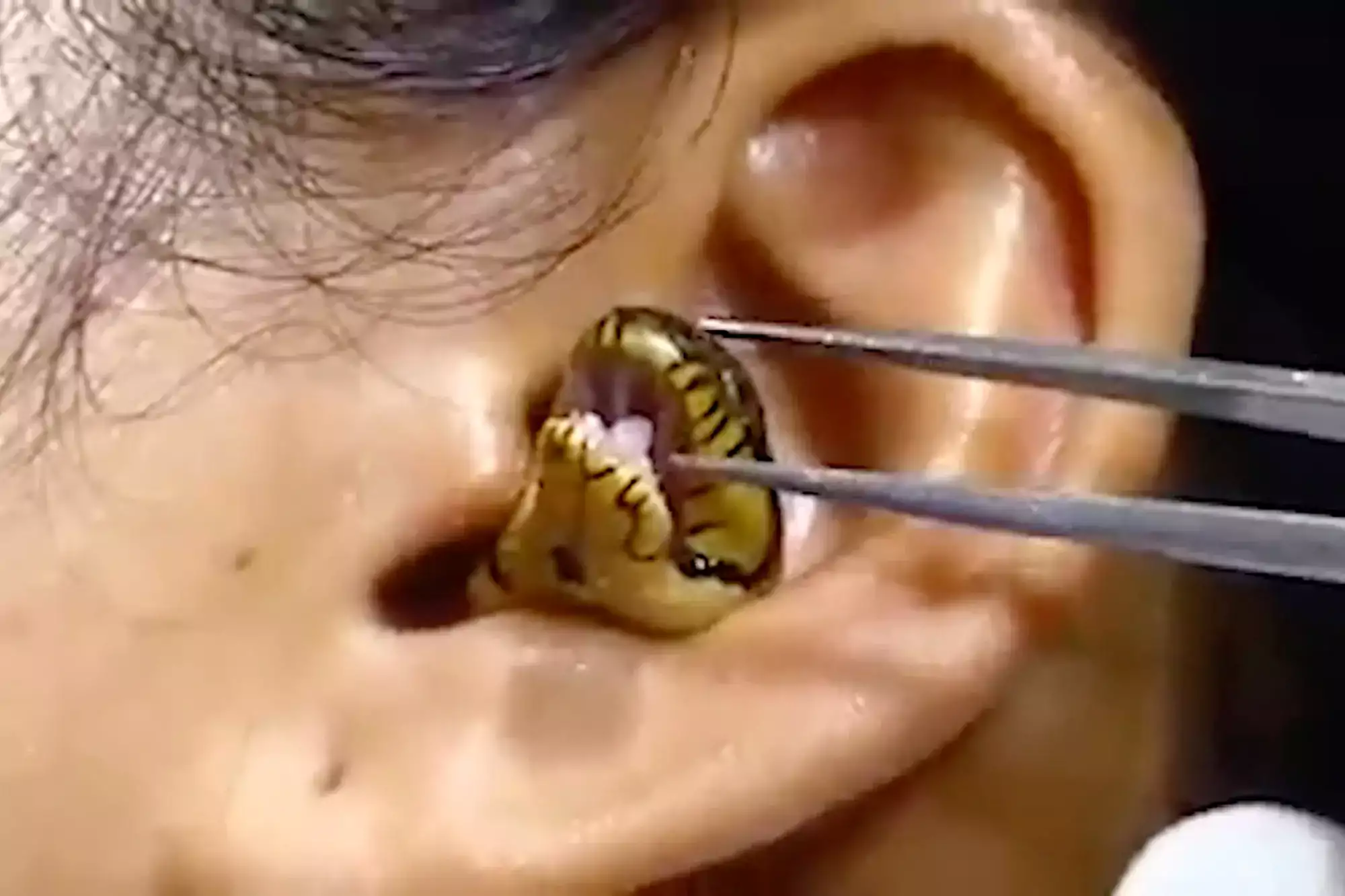 ‘Surgeon’ Struggles To Remove Live Snake From Woman’s Ear In Viral Video 1