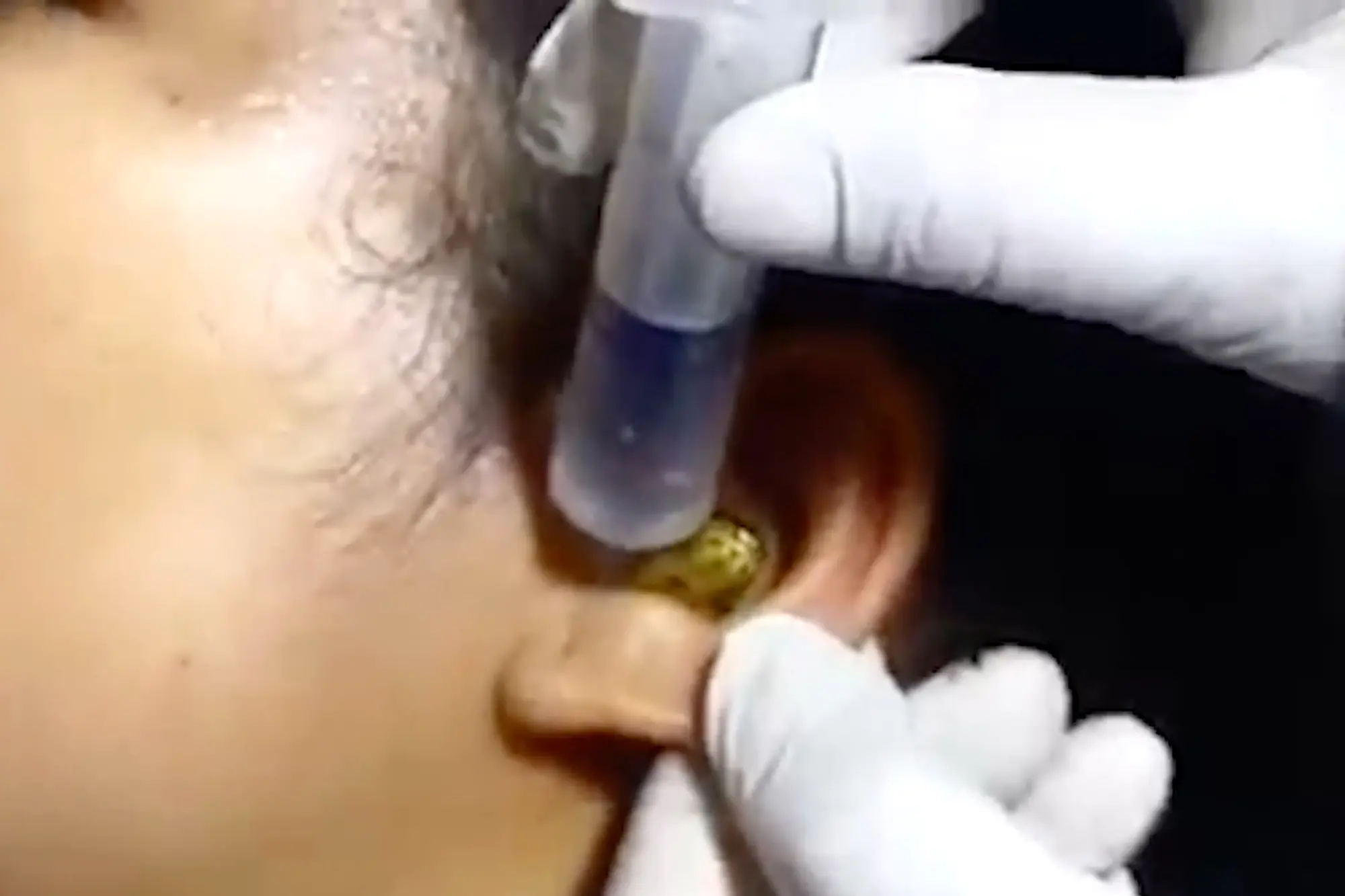 ‘Surgeon’ Struggles To Remove Live Snake From Woman’s Ear In Viral Video 
